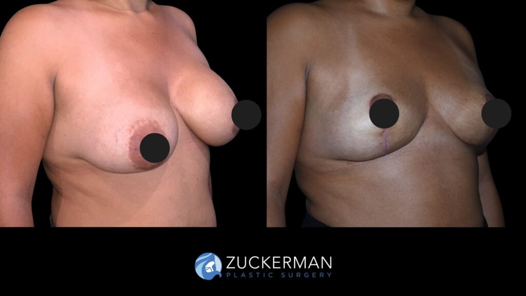 Patent before and after Mastopexy | Zuckerman Plastic Surgery