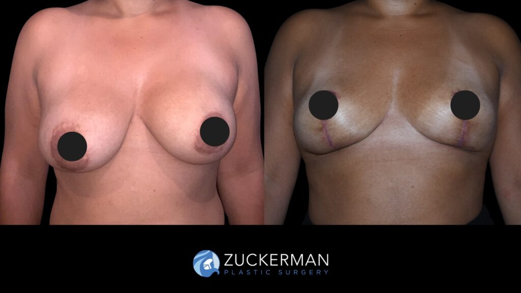Patent before and after Mastopexy | Zuckerman Plastic Surgery