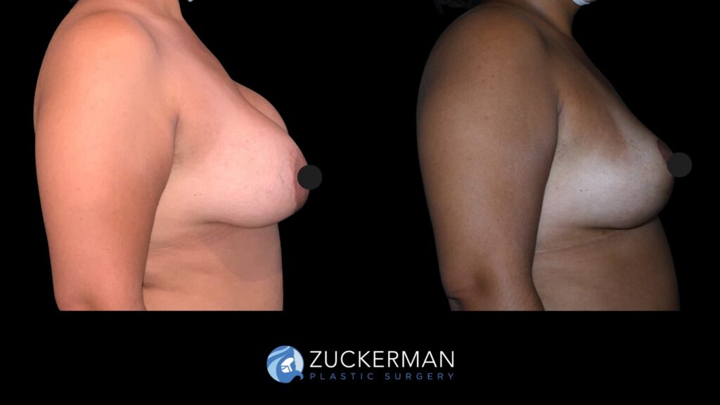 Patent before and after Mastopexy | Zuckerman Plastic Surgery
