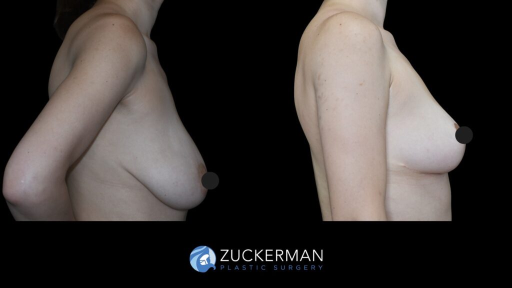 Patent before and after Breast Reduction | Zuckerman Plastic Surgery