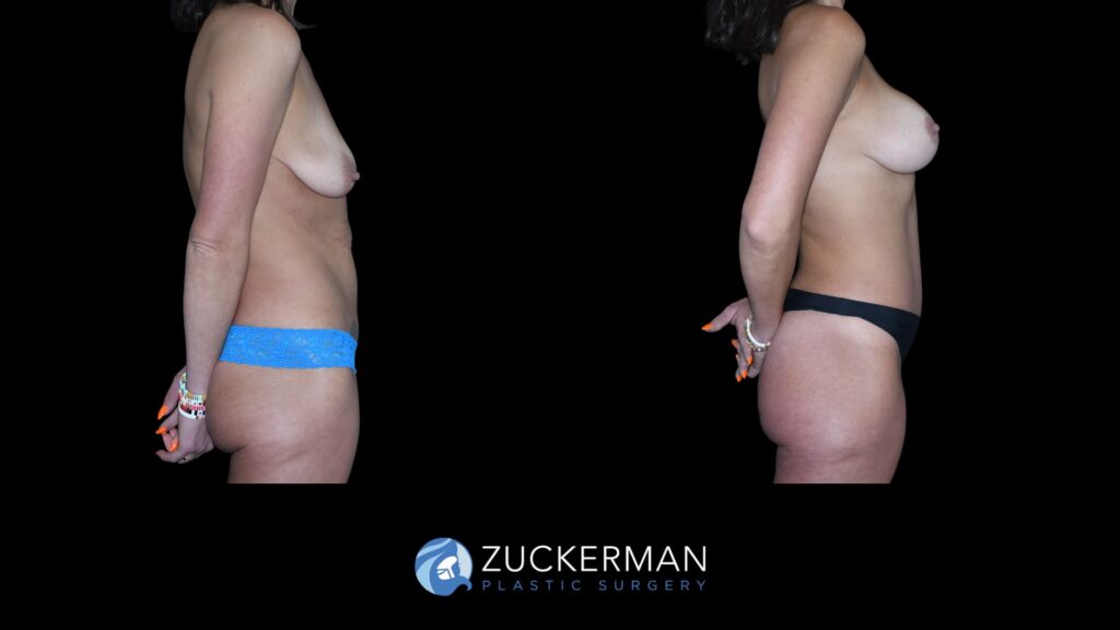 Patent before and after Tummy Tuck and Augmentation Mastopexy | Zuckerman Plastic Surgery