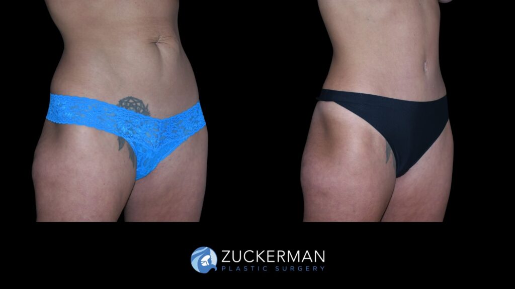 Patent before and after Tummy Tuck | Zuckerman Plastic Surgery
