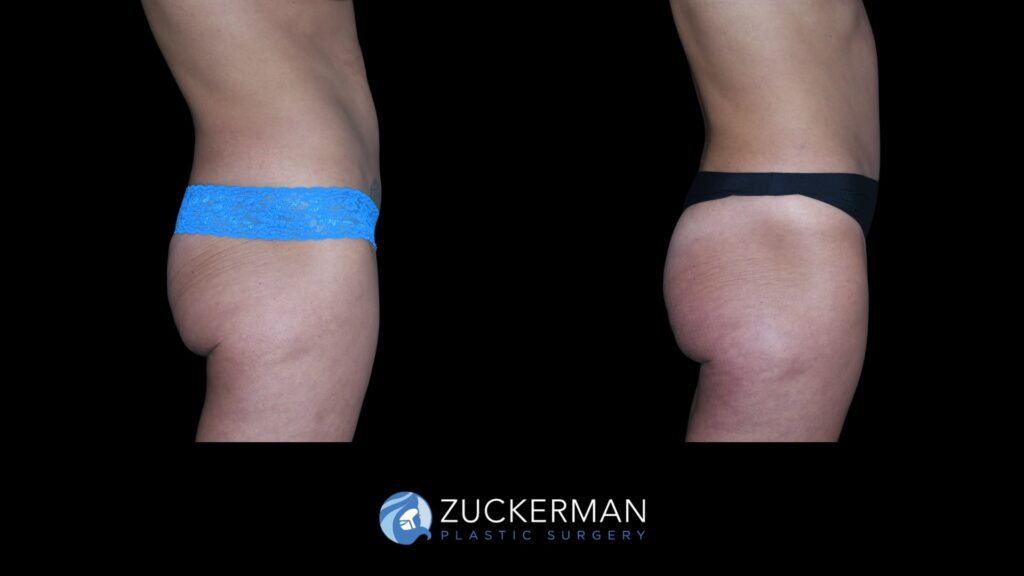 Patent before and after Tummy Tuck | Zuckerman Plastic Surgery