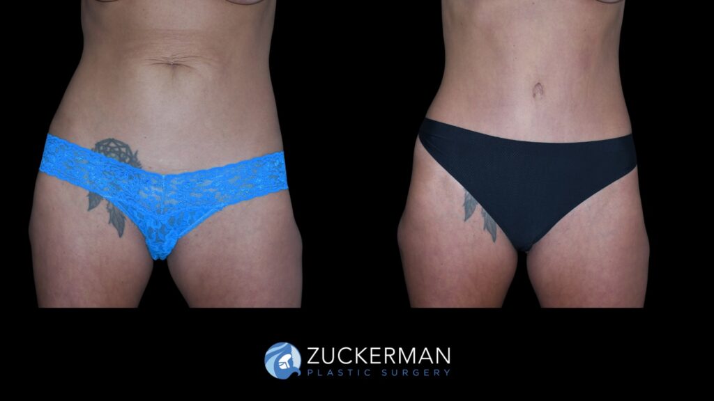 Patent before and after Tummy Tuck | Zuckerman Plastic Surgery
