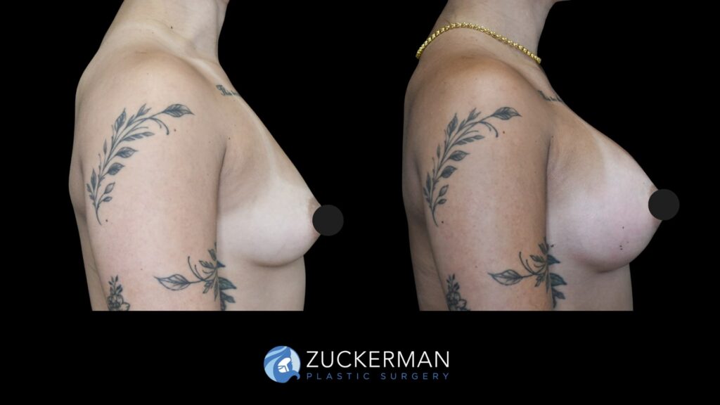 Patent before and after Breast Augmentation | Zuckerman Plastic Surgery