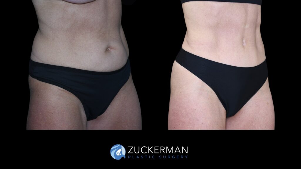 Patent before and after Tummy Tuck, Back Liposuction and Buttock Augmentation| Zuckerman Plastic Surgery