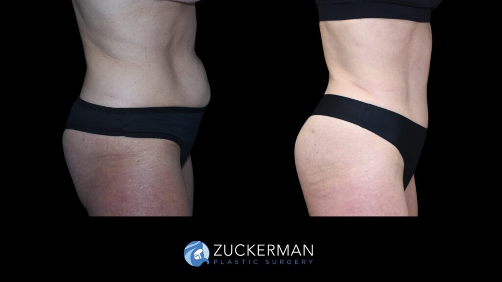 Patent before and after Tummy Tuck, Back Liposuction and Buttock Augmentation| Zuckerman Plastic Surgery