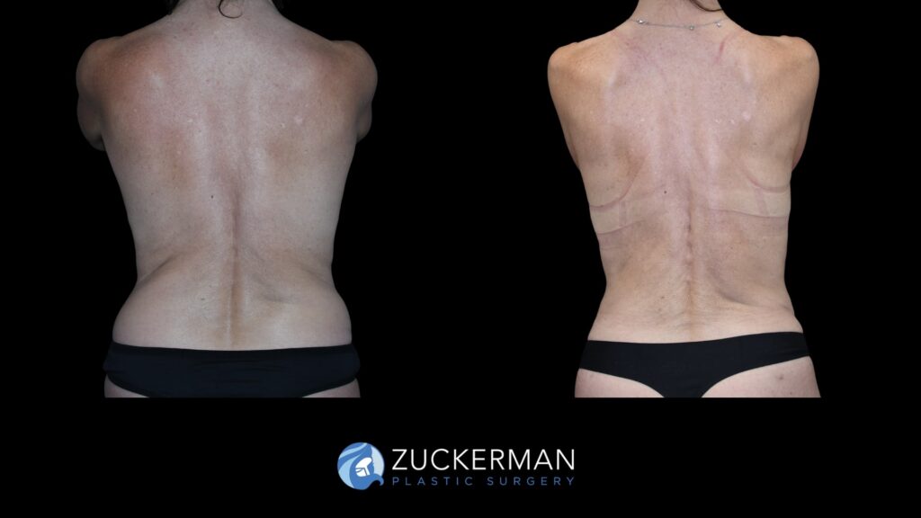 Patent before and after Tummy Tuck, Back Liposuction and Buttock Augmentation| Zuckerman Plastic Surgery