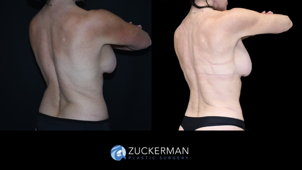 Patent before and after Tummy Tuck, Back Liposuction and Buttock Augmentation| Zuckerman Plastic Surgery