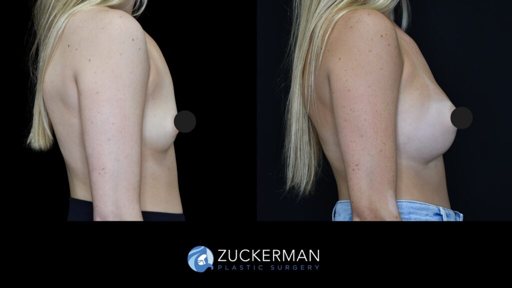 Patent before and after Breast Augmentation | Zuckerman Plastic Surgery