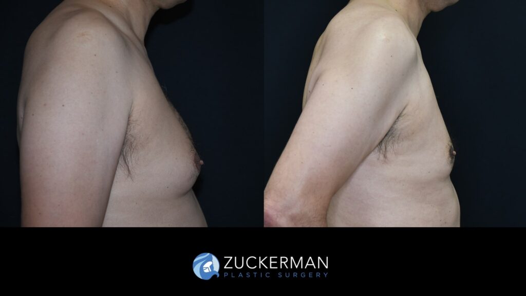 Male breast reduction (Gynecomastia correction surgery) by Dr. Zuckerman.