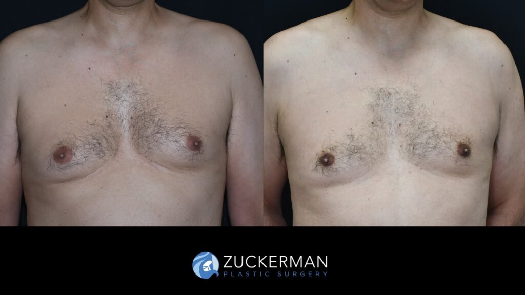 Male breast reduction (Gynecomastia correction surgery) by Dr. Zuckerman.
