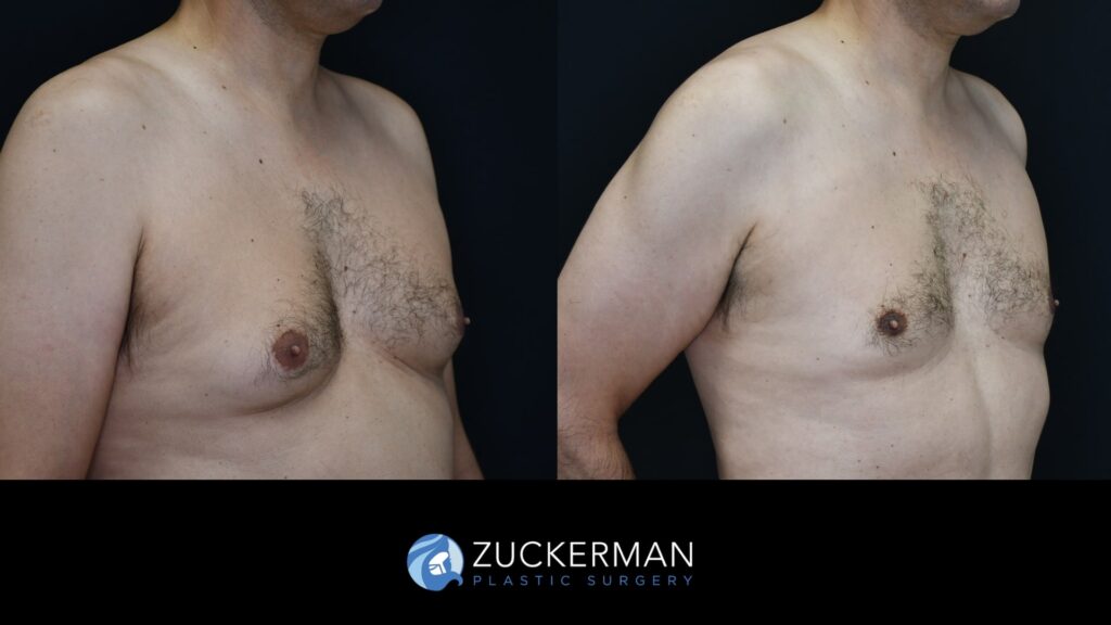 Patent before and after Male Liposuction and Male breast reduction (Gynecomastia correction surgery) by Dr. Zuckerman.