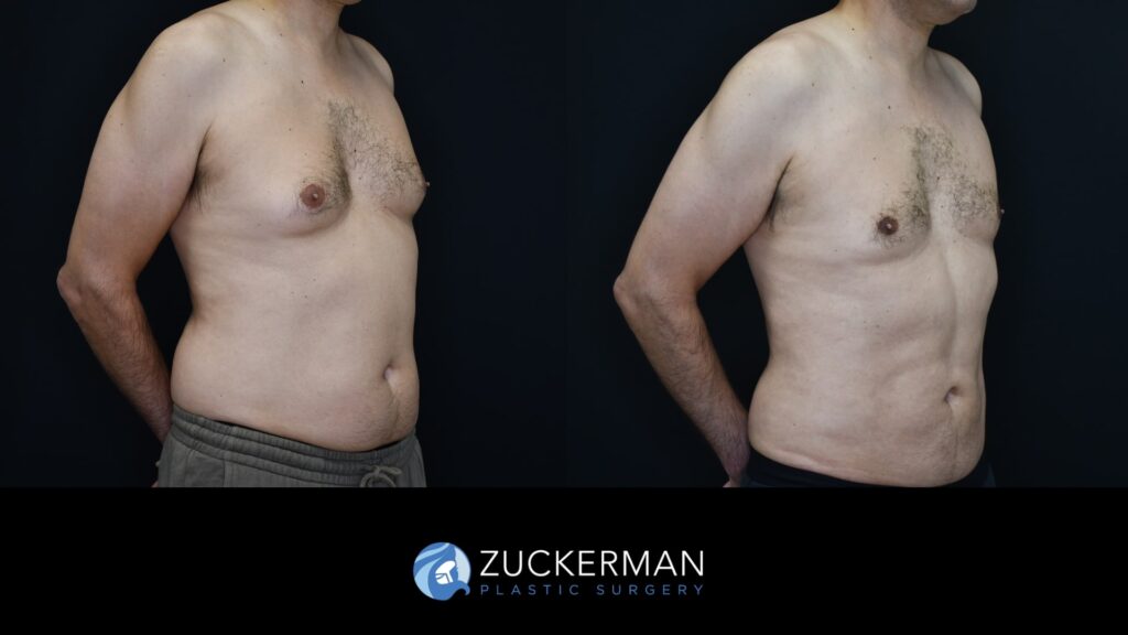 Patent before and after Male Liposuction and Male breast reduction (Gynecomastia correction surgery) by Dr. Zuckerman.