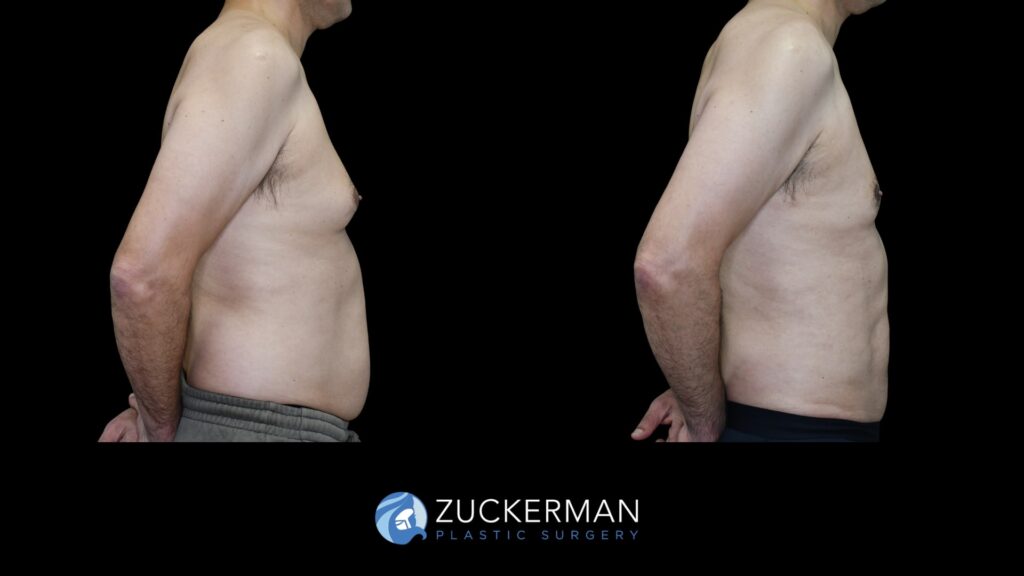 Patent before and after Male Liposuction and Male breast reduction (Gynecomastia correction surgery) by Dr. Zuckerman.