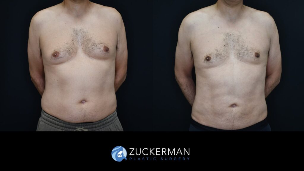 Patent before and after Male Liposuction and Male breast reduction (Gynecomastia correction surgery) by Dr. Zuckerman.
