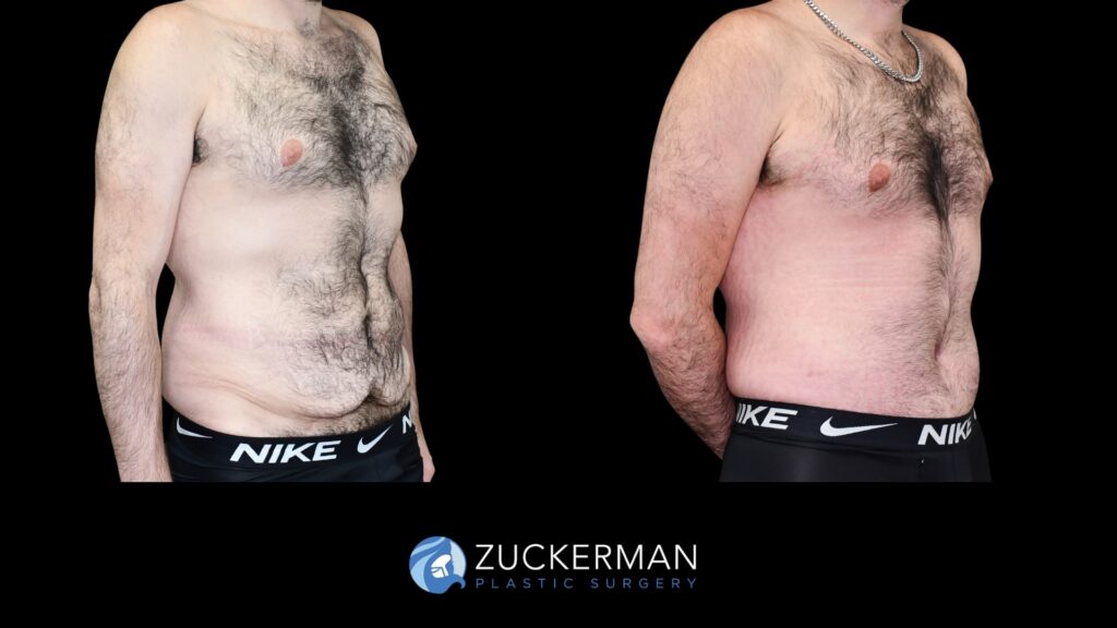 Patent before and after Male Circumferential Lift and Male Tummy Tuck (Abdominoplasty) by Dr. Zuckerman.