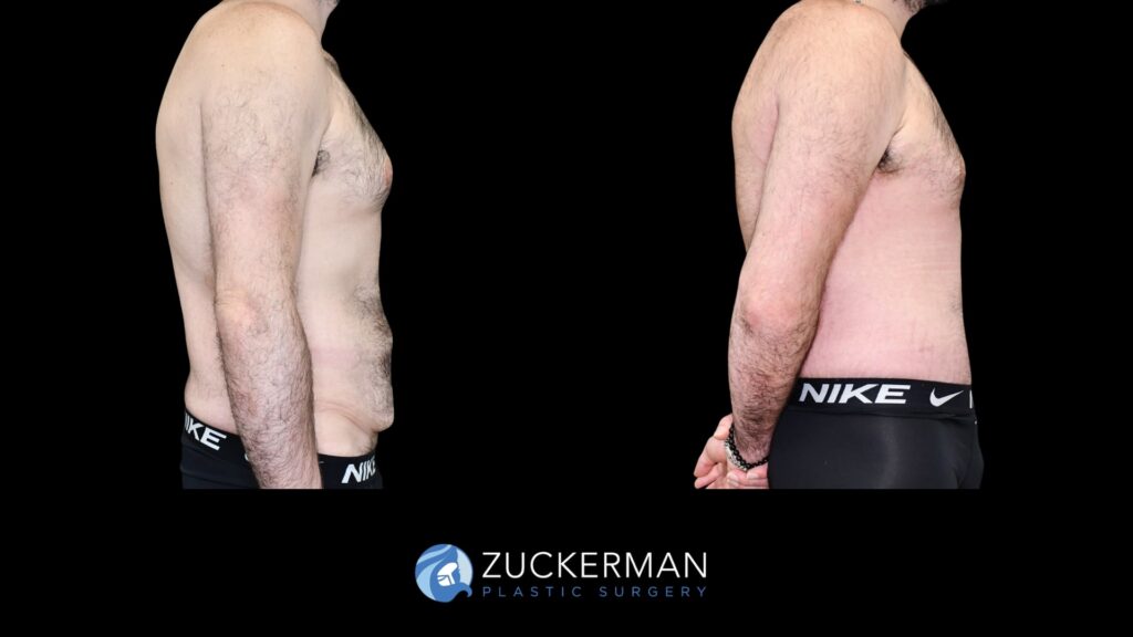 Patent before and after Male Circumferential Lift and Male Tummy Tuck (Abdominoplasty) by Dr. Zuckerman.