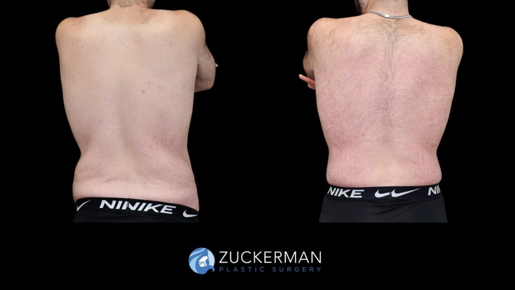 Patent before and after Male Circumferential Lift and Male Tummy Tuck (Abdominoplasty) by Dr. Zuckerman.