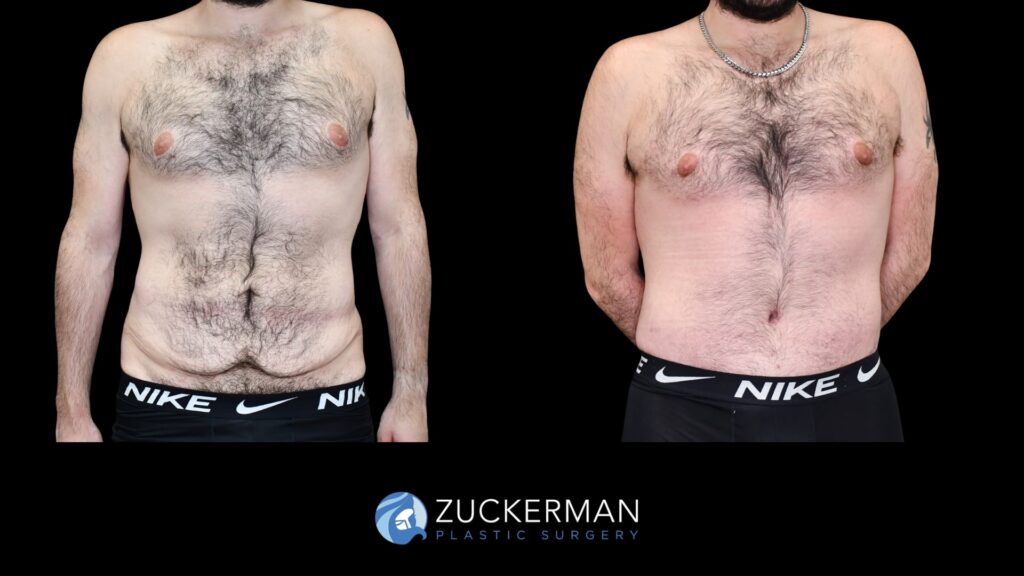 Patent before and after Male Circumferential Lift and Male Tummy Tuck (Abdominoplasty) by Dr. Zuckerman.