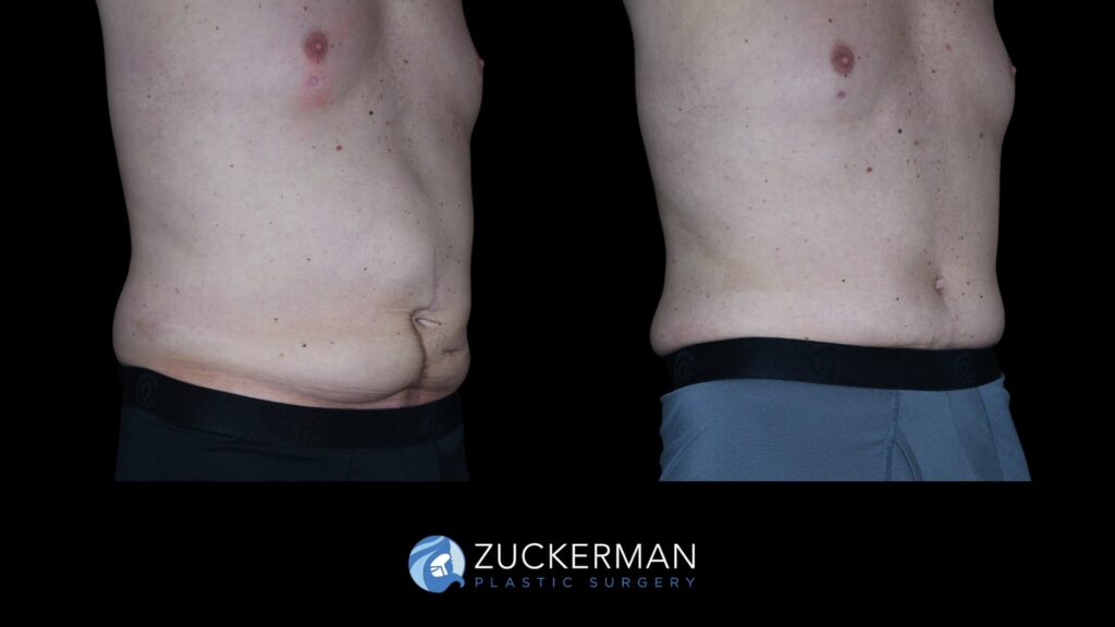 Patent before and after Male Circumferential Lift by Dr. Zuckerman.