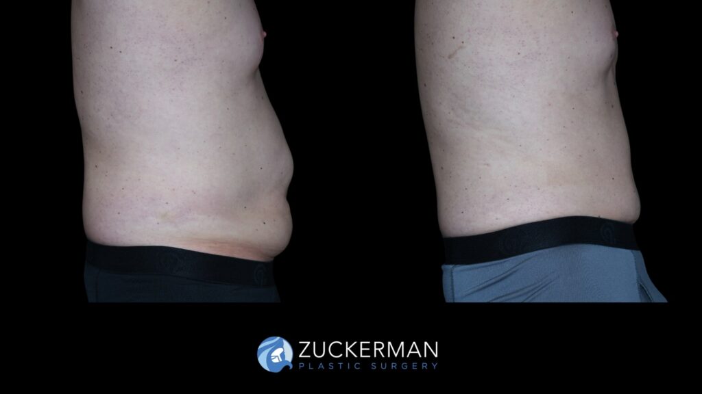 Patent before and after Male Circumferential Lift by Dr. Zuckerman.