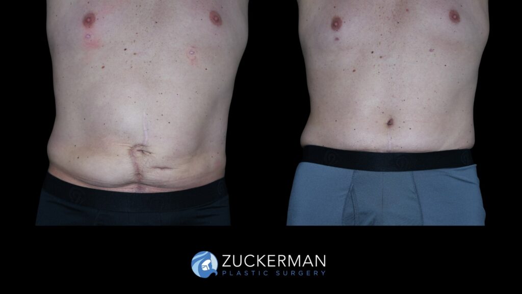 Patent before and after Male Circumferential Lift by Dr. Zuckerman.