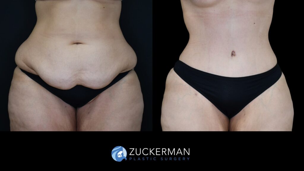 Patient before and after Tummy Tuck (Abdominoplasty) by Dr. Zuckerman.
