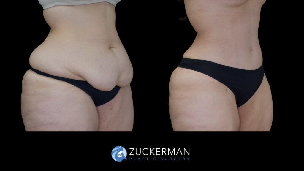 Patient before and after Tummy Tuck (Abdominoplasty) by Dr. Zuckerman.