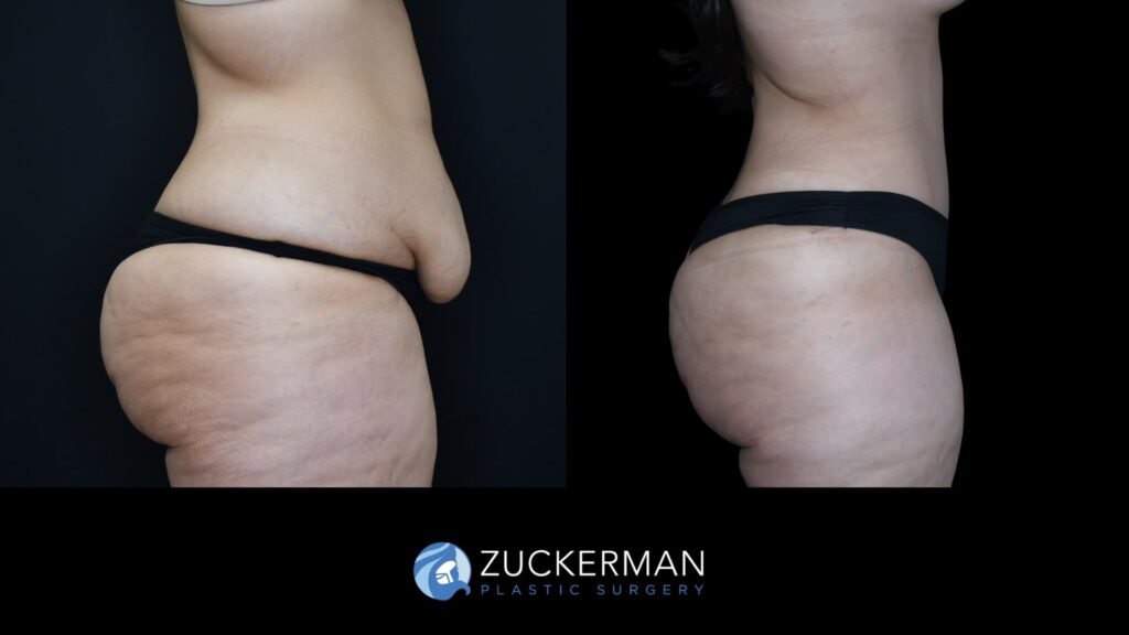 Patient before and after Tummy Tuck (Abdominoplasty) by Dr. Zuckerman.