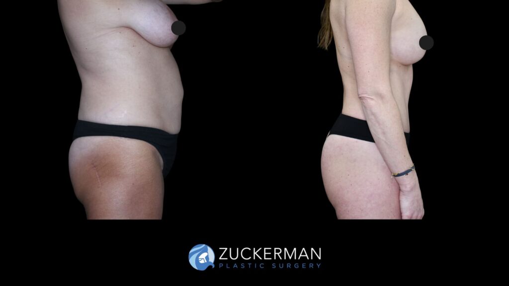 Female patient before and after tummy tuck, mastopexy, and back liposuction, side view