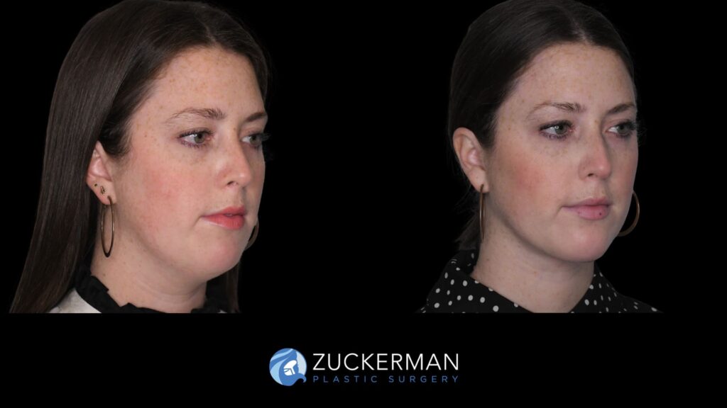 Female patient before and after chin implant and submental lipo, right oblique view