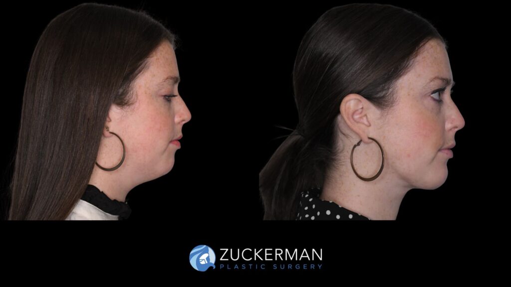 Female patient before and after chin implant and submental lipo, right side view