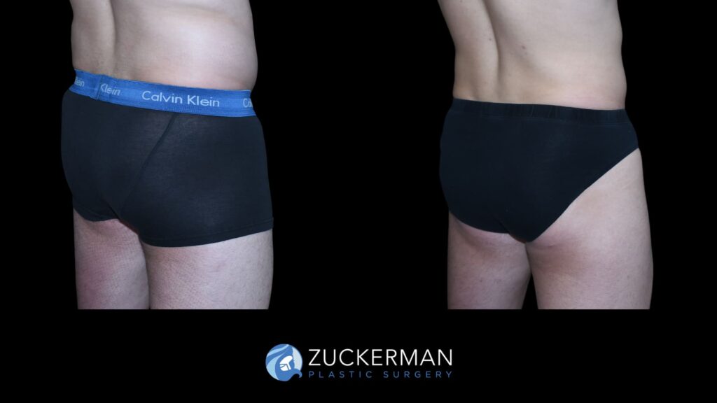 Male patient before and after Buttock Augmentation (BBL), right oblique view