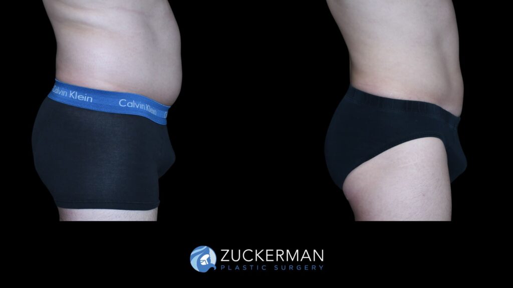 Male patient before and after Buttock Augmentation (BBL), right side view