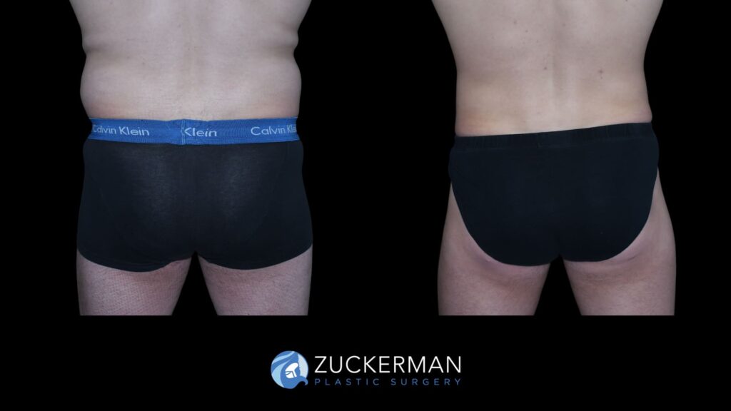 Male patient before and after Buttock Augmentation (BBL), back view