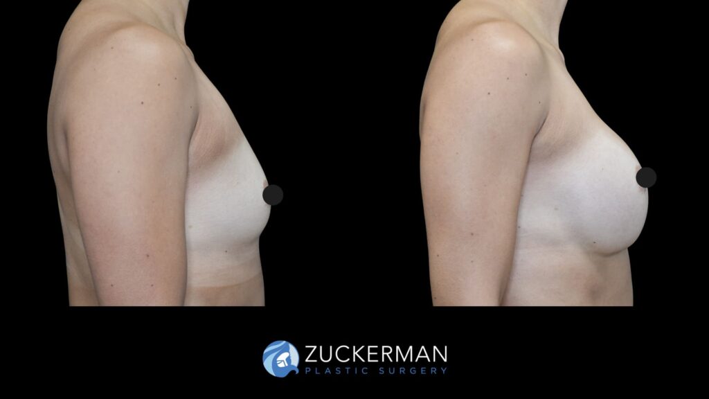 female patient before and after breast augmentation, right side view