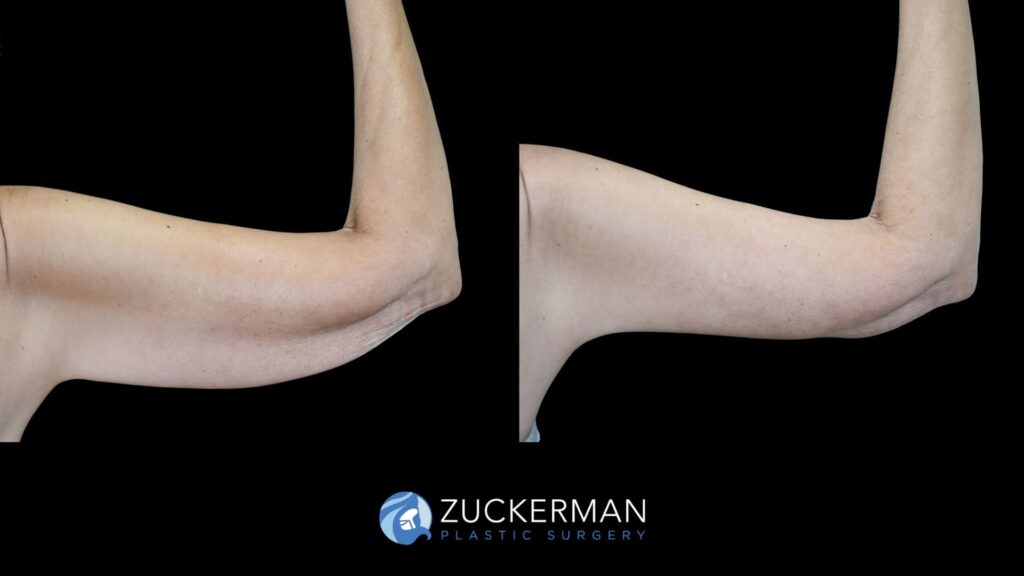 female patient before and after brachioplasty