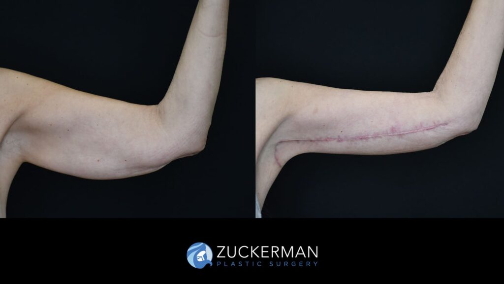 female patient before and after brachioplasty