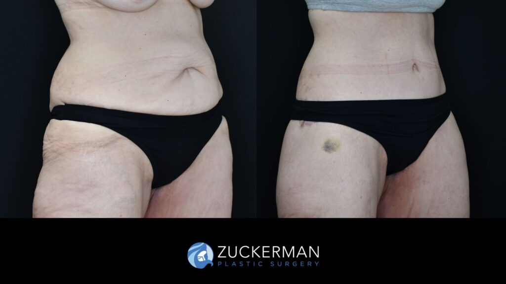 female patient before and after circumferential body lift with buttock auto-augmentation, right oblique view