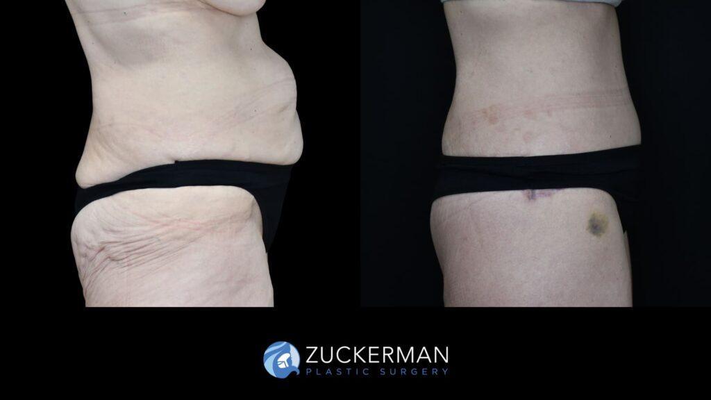 female patient before and after circumferential body lift with buttock auto-augmentation, right side view