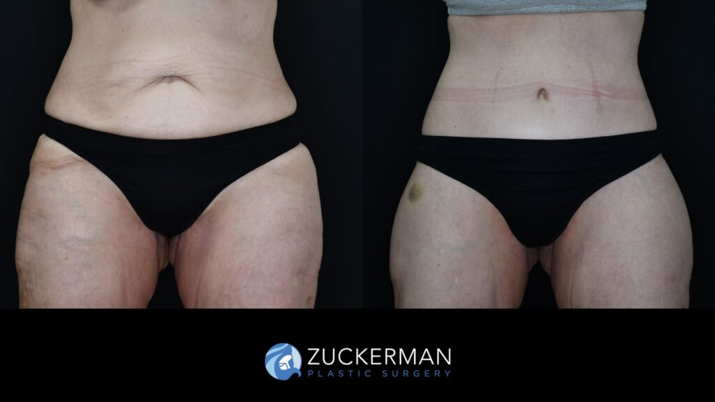 female patient before and after circumferential body lift with buttock auto-augmentation, front view