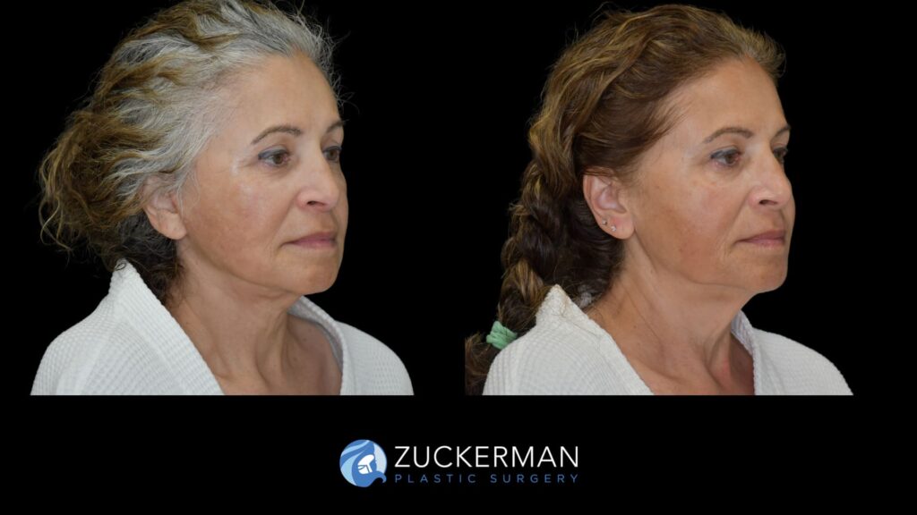 female patient before and after facelift, right oblique view