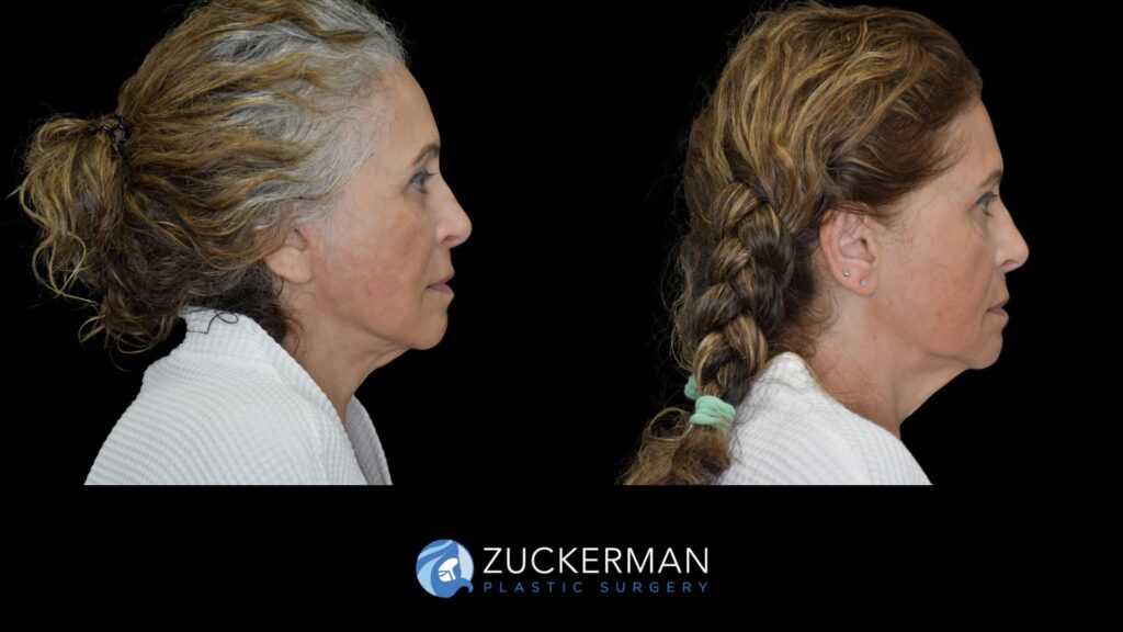 female patient before and after facelift, right side view