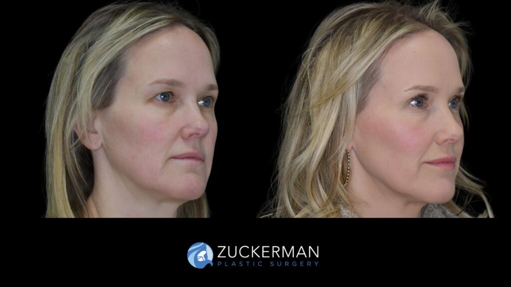 female patient before and after upper blepharoplasty and CO2 laser resurfacing of the face and neck, right oblique view
