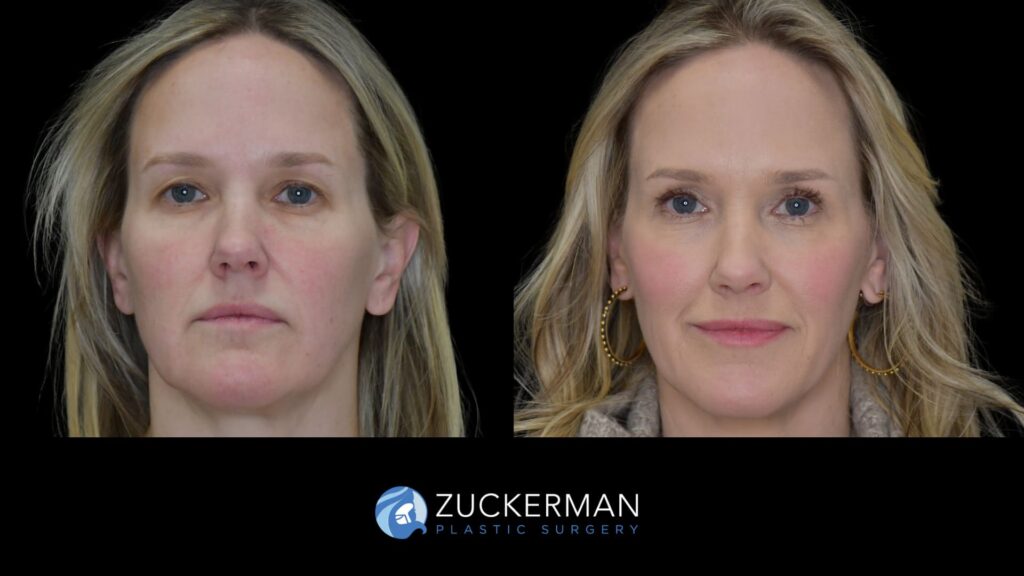 female patient before and after upper blepharoplasty and CO2 laser resurfacing of the face and neck, front view