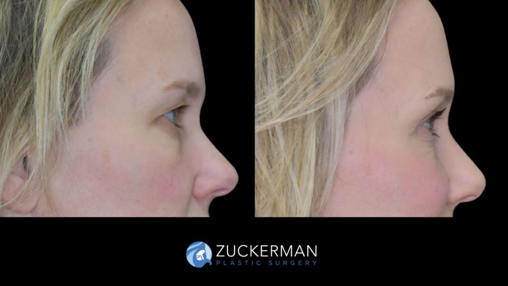 female patient before and after upper blepharoplasty and CO2 laser resurfacing of the face and neck, right side view