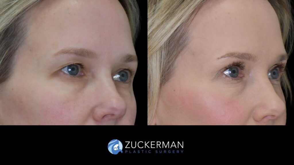 female patient before and after upper blepharoplasty and CO2 laser resurfacing of the face and neck, right oblique view