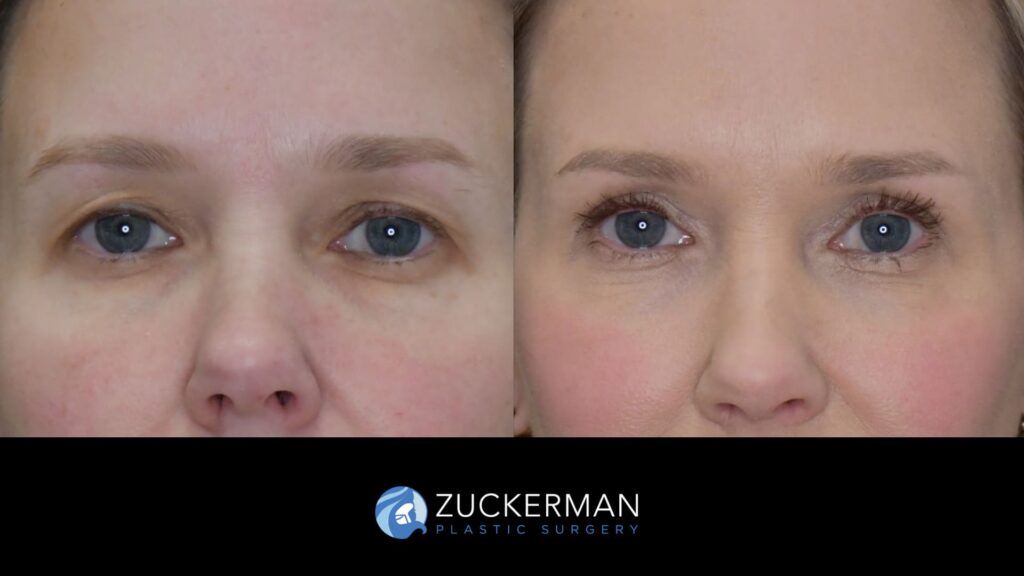 female patient before and after upper blepharoplasty and CO2 laser resurfacing of the face and neck, front view