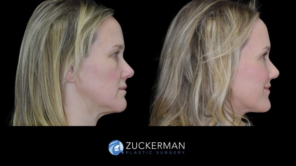 female patient before and after upper blepharoplasty and CO2 laser resurfacing of the face and neck, right side view